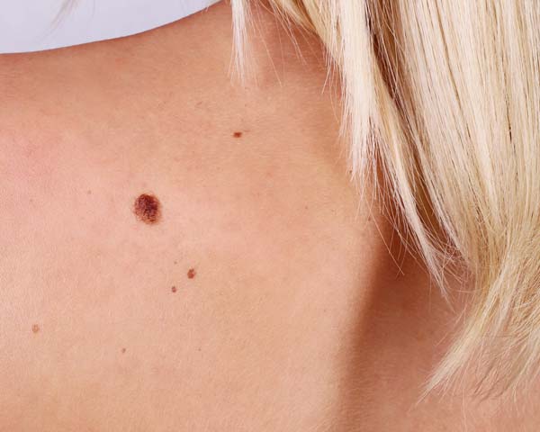 promo_images_600x480_moles